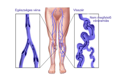 vénák visszér és kezelés