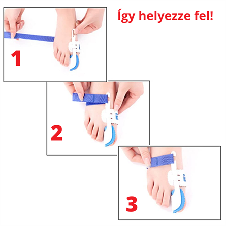 Éjszakai bütyökkorrigáló sín